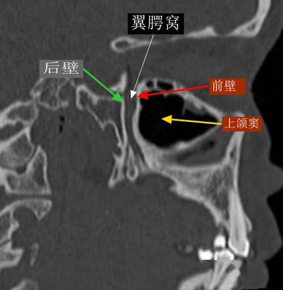 一文搞懂复杂解剖翼腭窝