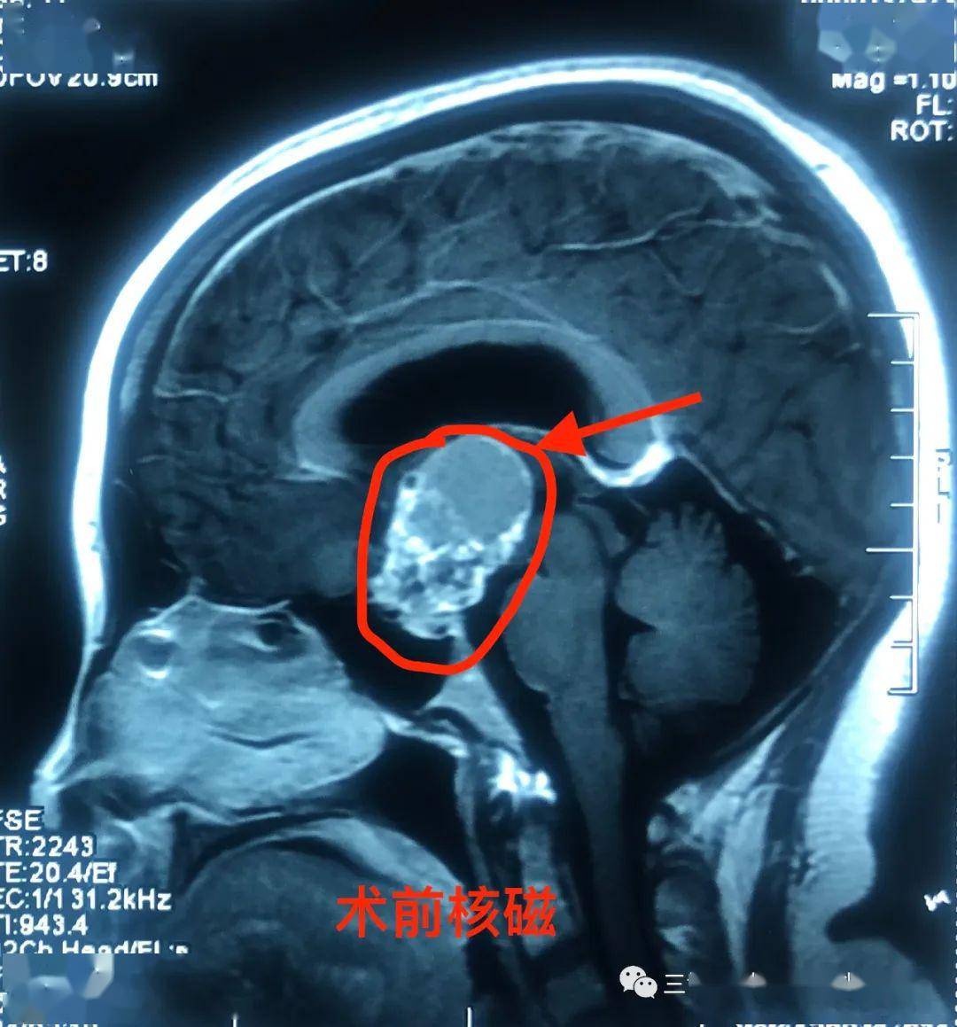 视物模糊要警惕鞍区肿瘤的可能