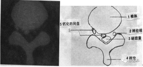 与读ct片相关的结构: 椎间盘(纤维环和髓核),椎间管,硬膜囊,脊髓,神经