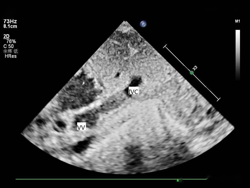 超声医生如何理清诊断思路:完全性肺静脉异位引流(心下型)