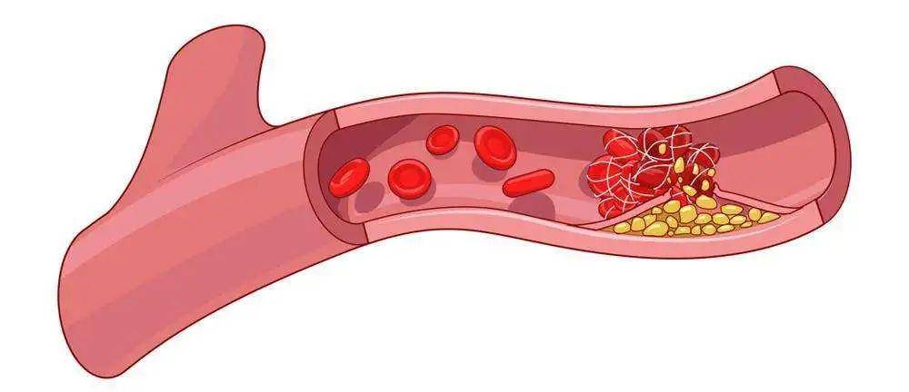 血栓脱落很危险
