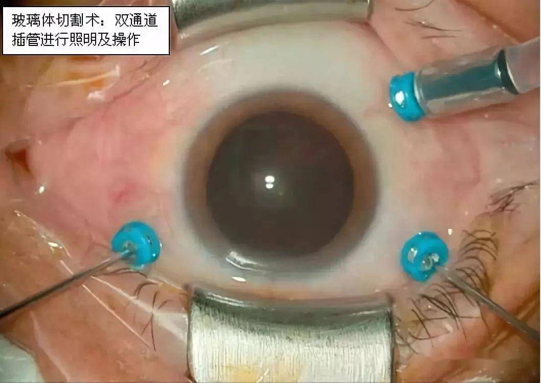 眼底病患者福音到了临沧市人民医院开展玻璃体切除手术治疗眼底疾病