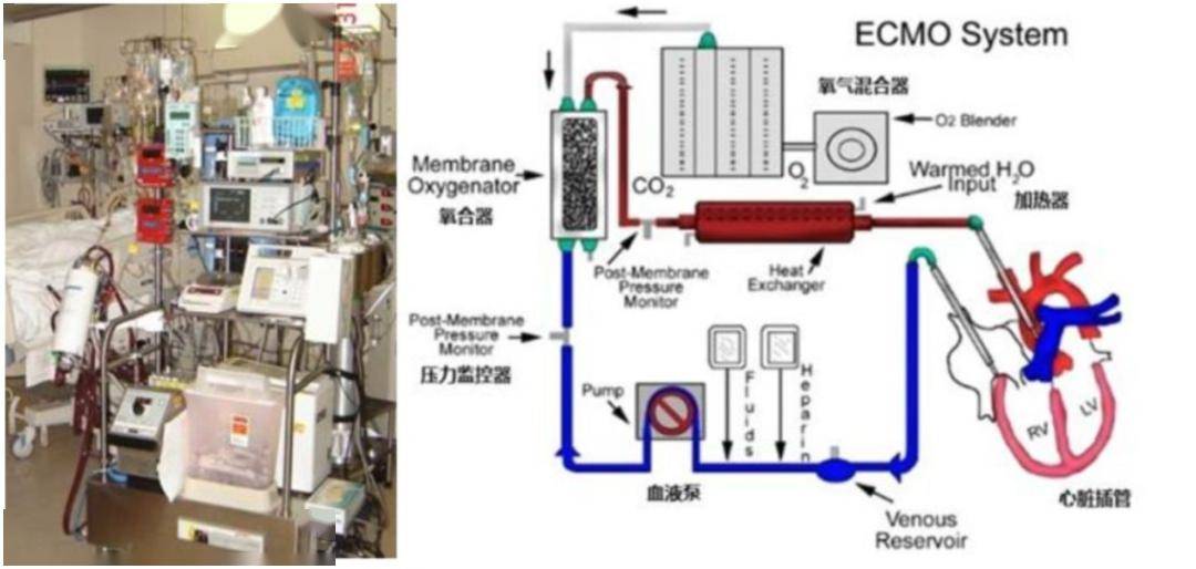 ecmo一响,黄金万两,这个垄断领域终于有了国产机!