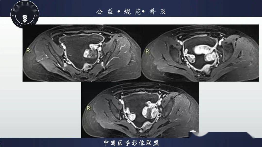 盆腔丨盆腔腺泡状横纹肌肉瘤