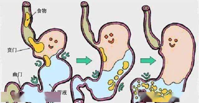 饭后反酸水,烧心,反复不断!当心"胃食管反流病"!
