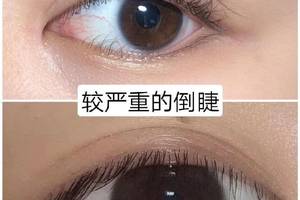 倒睫需要做双眼皮手术吗?