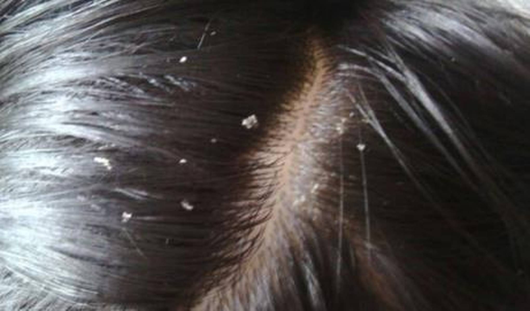 头皮屑增多洗不掉，无非是这5个原因，3招帮你洗掉头屑