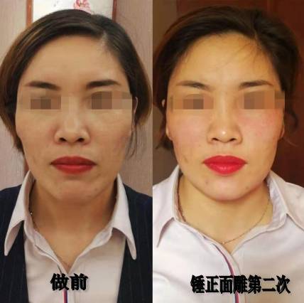 徒手整形对比图片