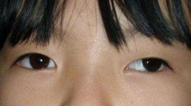 正常的眼睛在视物时能保持双眼集中在同一目标上,而有斜视的孩子则