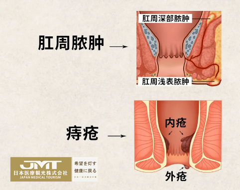 jmt日本医疗-痔疮,肛周脓肿是否有发展成直肠癌的风险