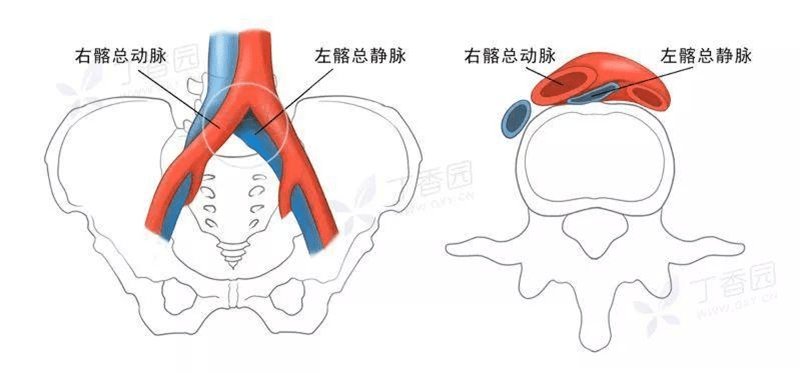 造成髂静脉长期受压刺激,引起管腔变窄,下肢静脉回流障碍,临床表现为