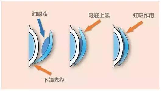 【科视眼科】佩戴角膜塑形镜会不会引起干眼?