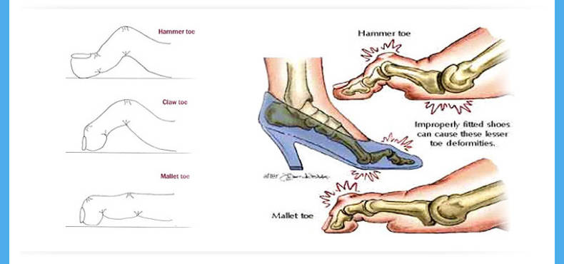 拇外翻产生的槌状趾