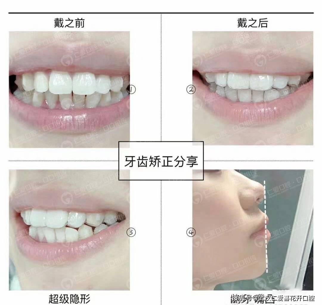 牙齿整齐只是深覆合需要做矫正吗