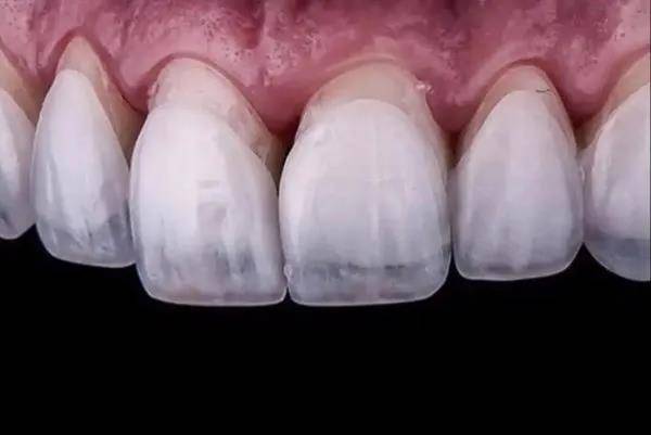 形态异常牙,牙釉质发育不良,过小牙等. 2.