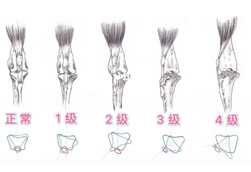 二导致髌骨脱位危险因素 三临床表现及分类 四髌骨脱位的治疗(重点