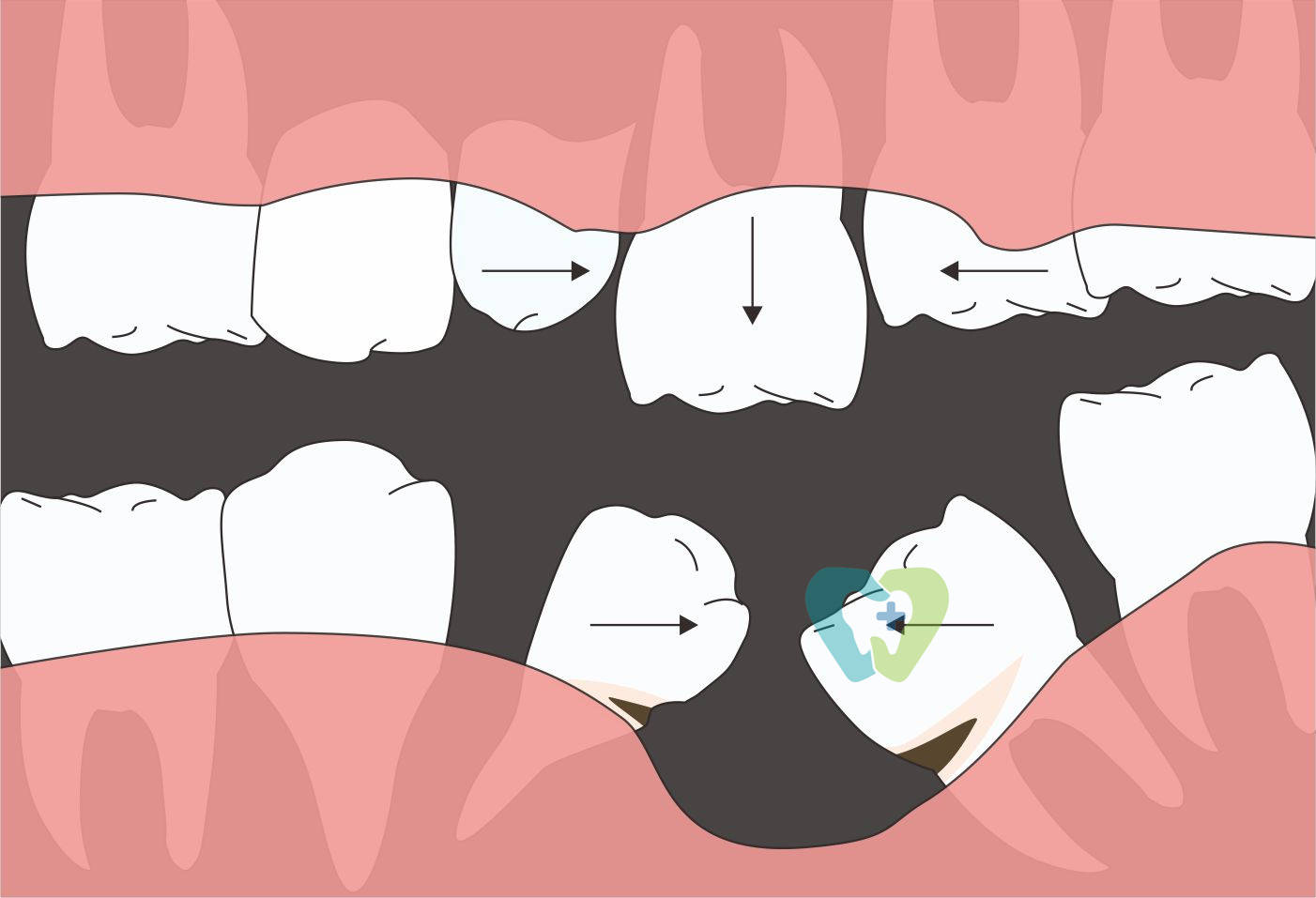 现在常见的方式有种牙,牙桥和活动假牙等