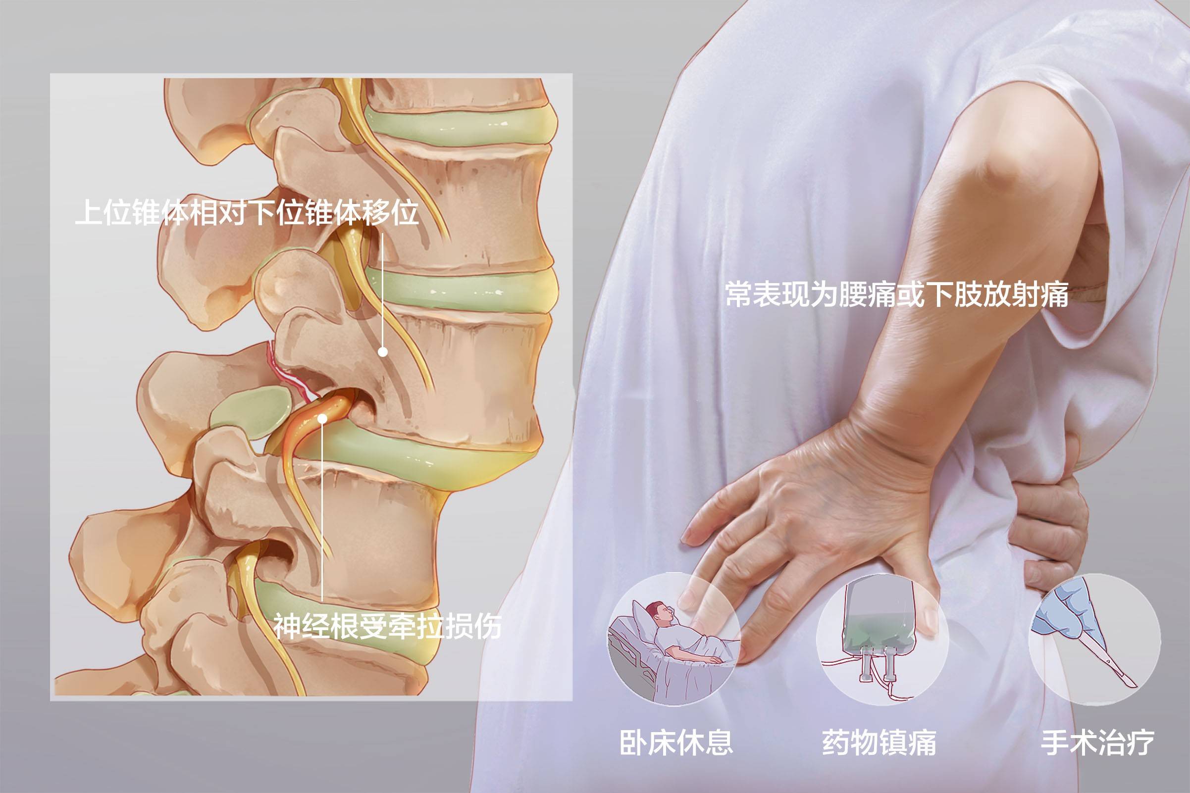 腰椎间盘突出和腰椎滑脱到底有没有关系