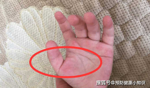 原创肝不好的人手上3个印记很明显拖久肝癌或会兴风作浪