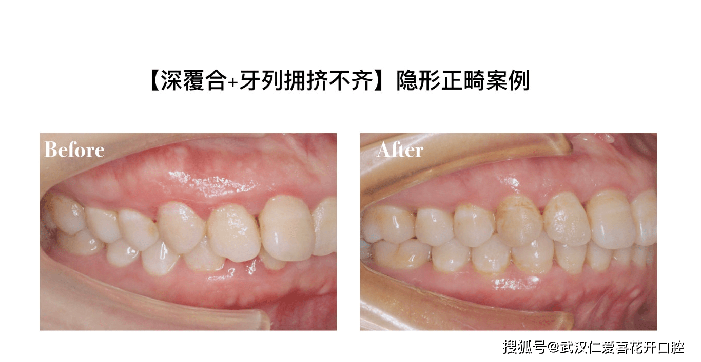 正畸前后口内照对比