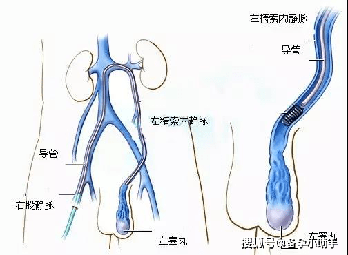 4,其他病灶 来自输精管道本身或邻近器官肿瘤压迫所致管腔不通,也是