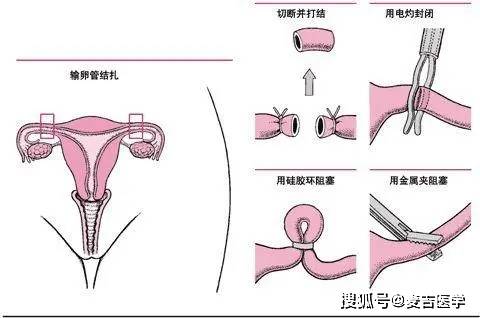 原创男性"结扎"后会影响性功能吗?和正常人有什么区别?一文说清楚