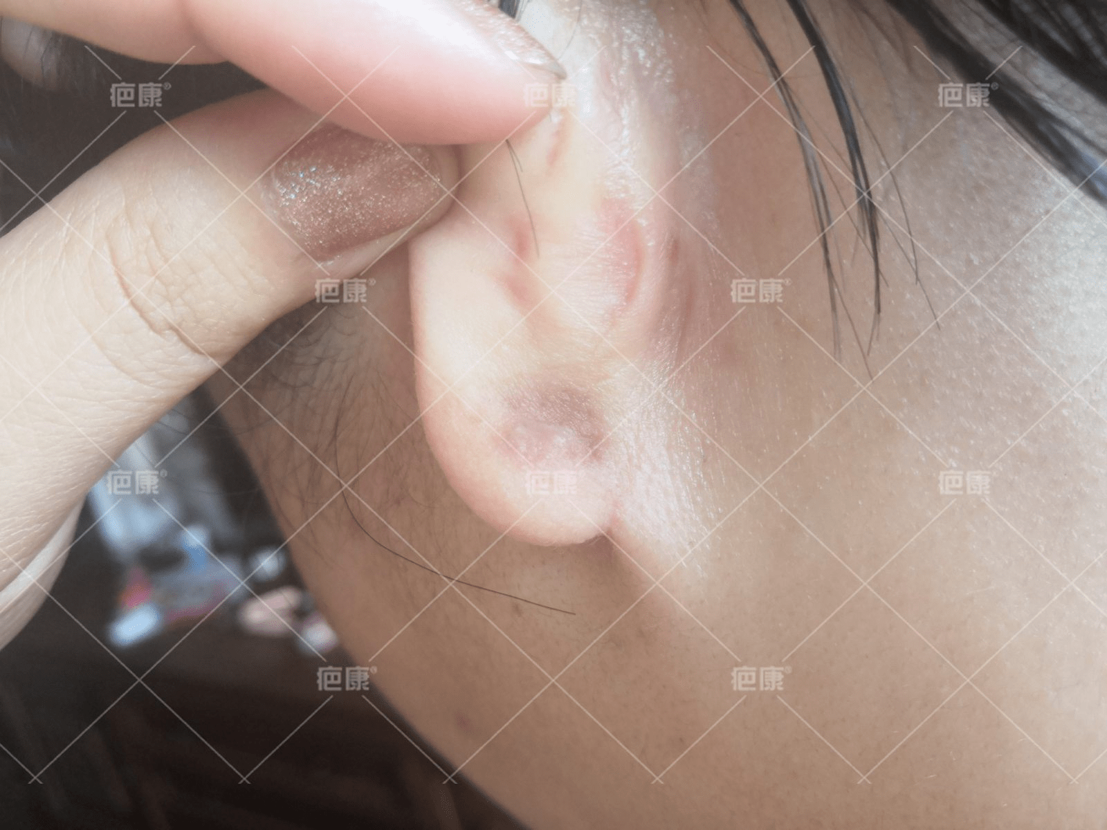 (疤康)耳朵疤痕疙瘩需要做手术吗?