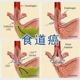 食道癌能活多久nk细胞疗法效果