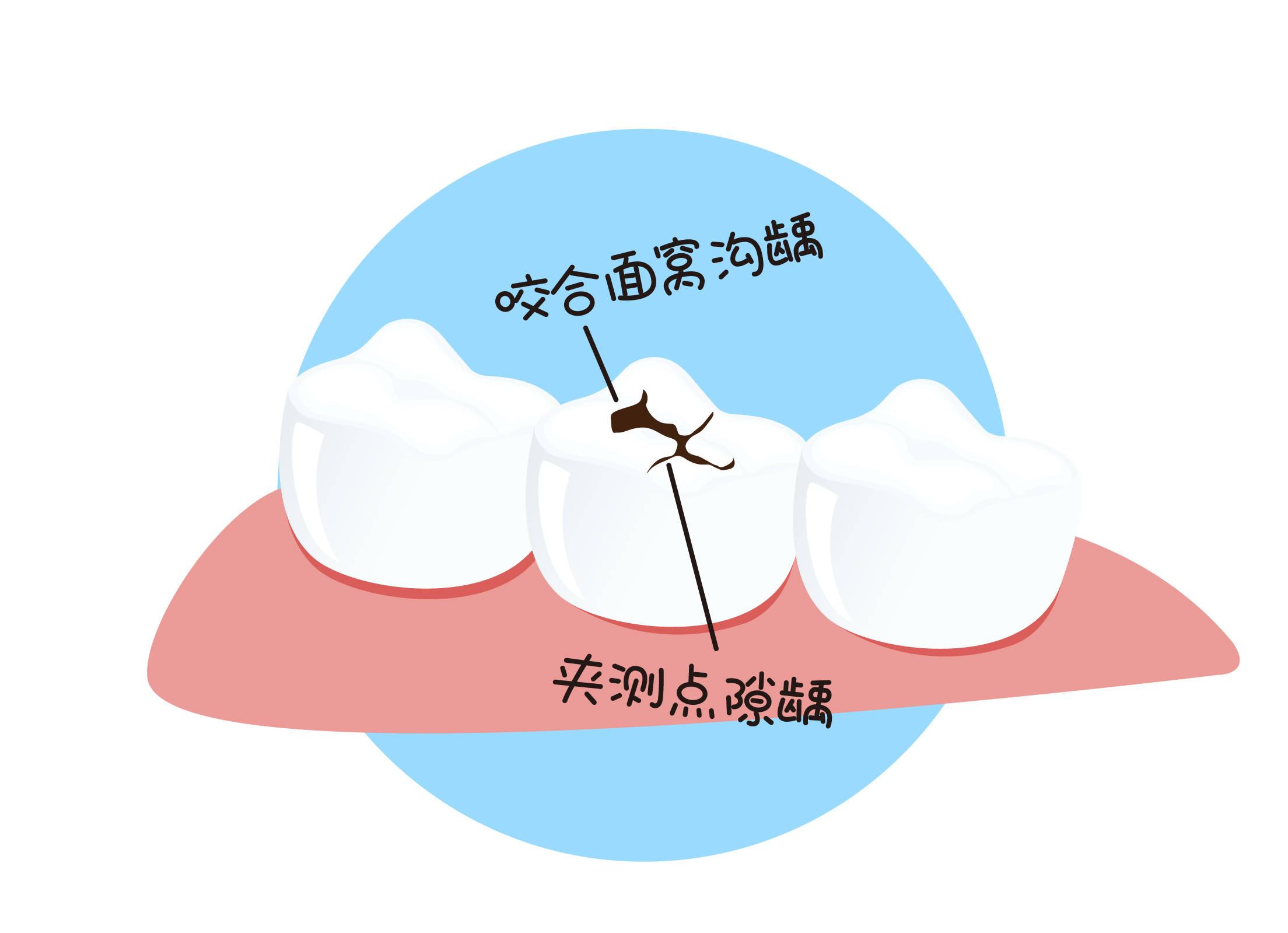 沟窝封闭的3个关键期:不想花大钱带娃看牙,就千万别错过!