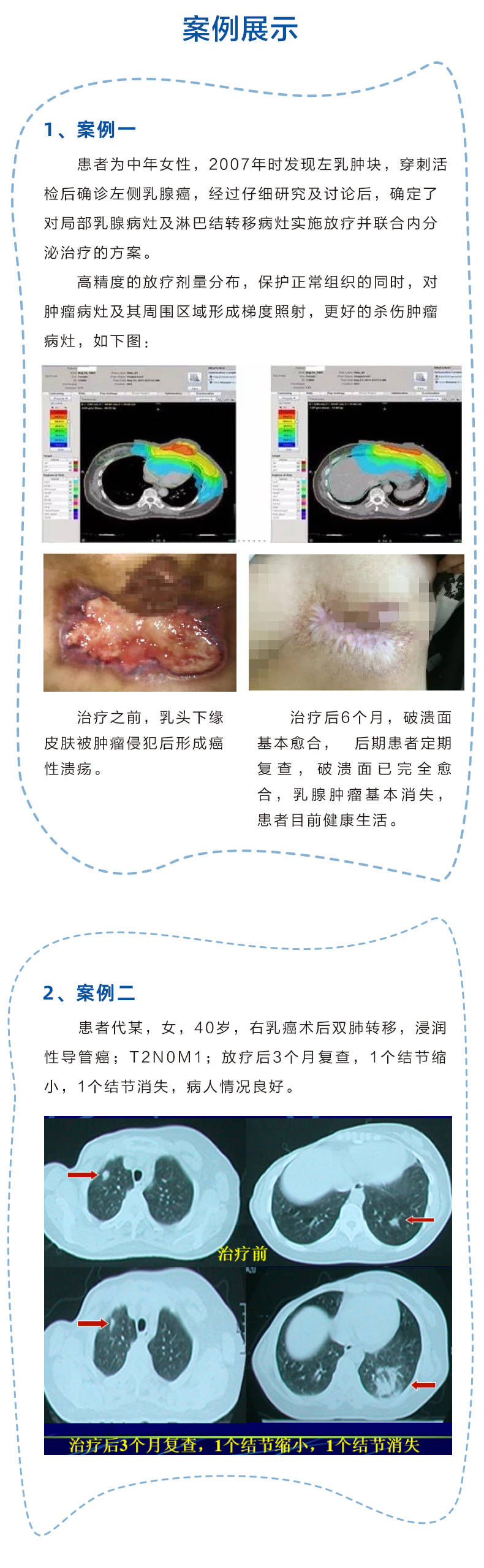 【肿瘤放疗科普】乳腺癌诊疗知识(下)