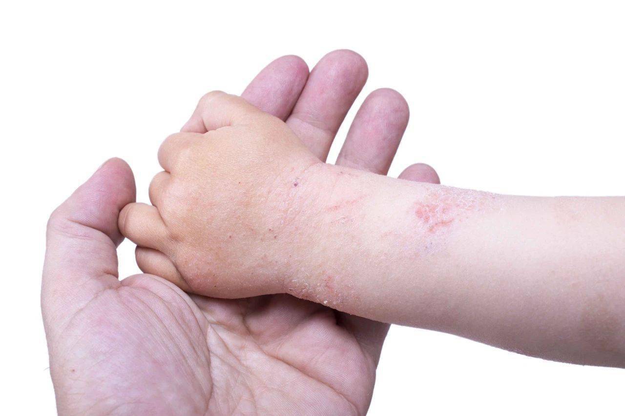 和成人荨麻疹有哪些差异?