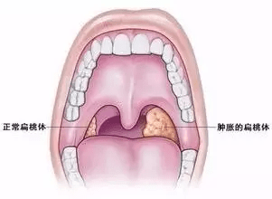 潍坊耳鼻喉专家介绍儿童扁桃体发炎是否需要手术切除?