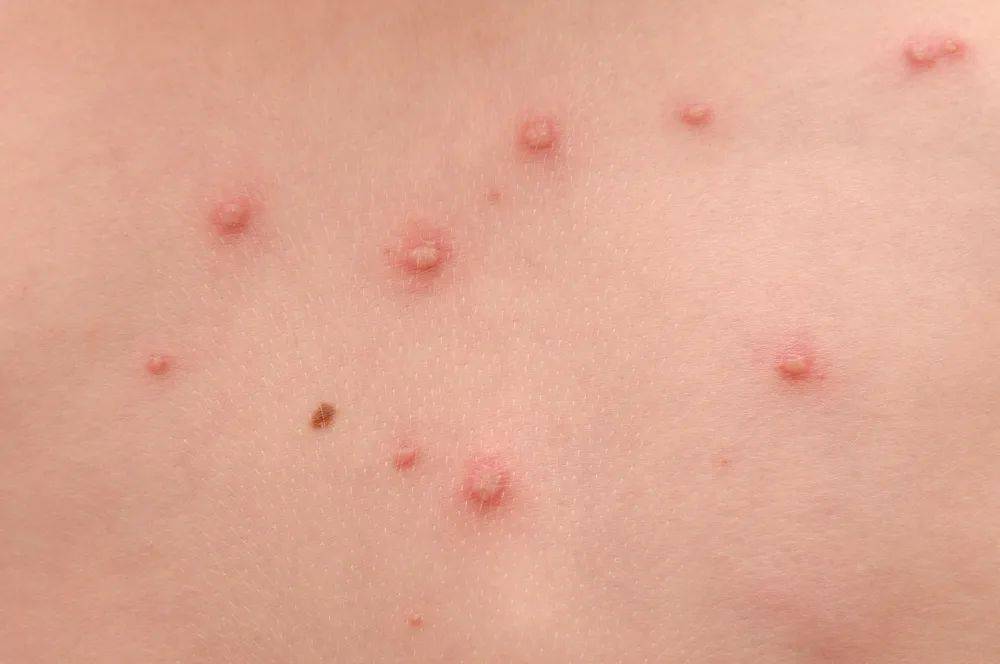 如果持续感染低危hpv,患病初期女性私处会出现淡红色的丘疹,这种丘疹