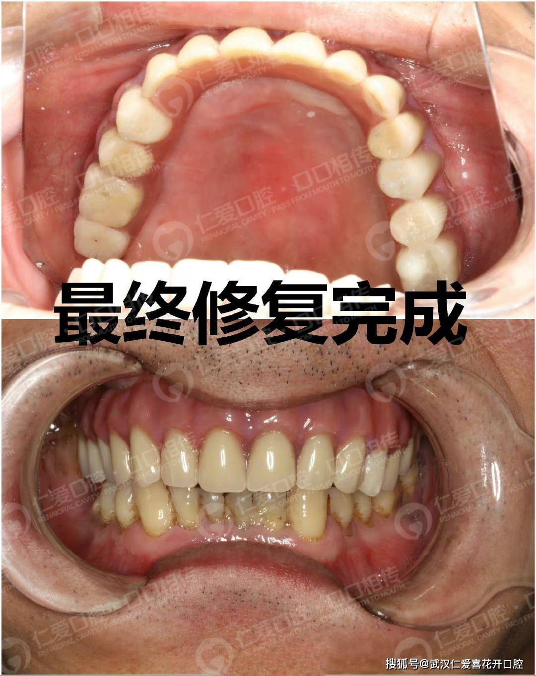 牙槽骨萎缩 ▎上颌窦内提升 植骨修复