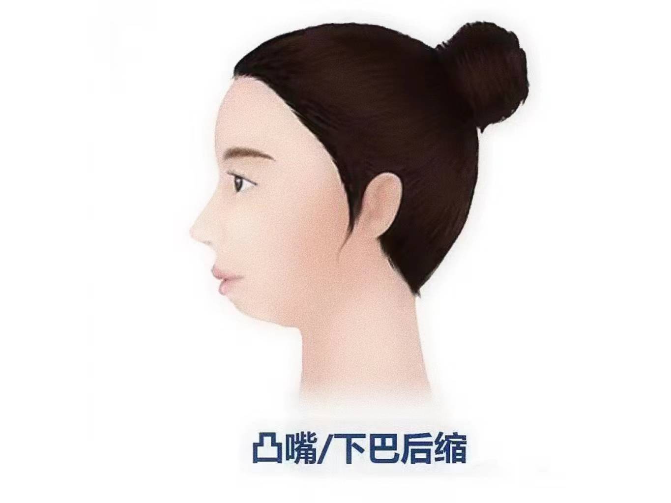 嘴巴突出,与鼻基底之间的(视觉)落差感大,鼻子显低,常伴有下巴后缩