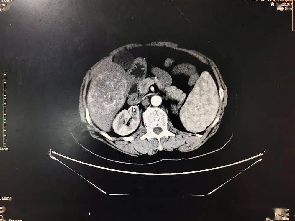 ct影像:肝脏肿瘤微创下肝断面被切除的肝巨大肿瘤术后切口腹腔镜肝