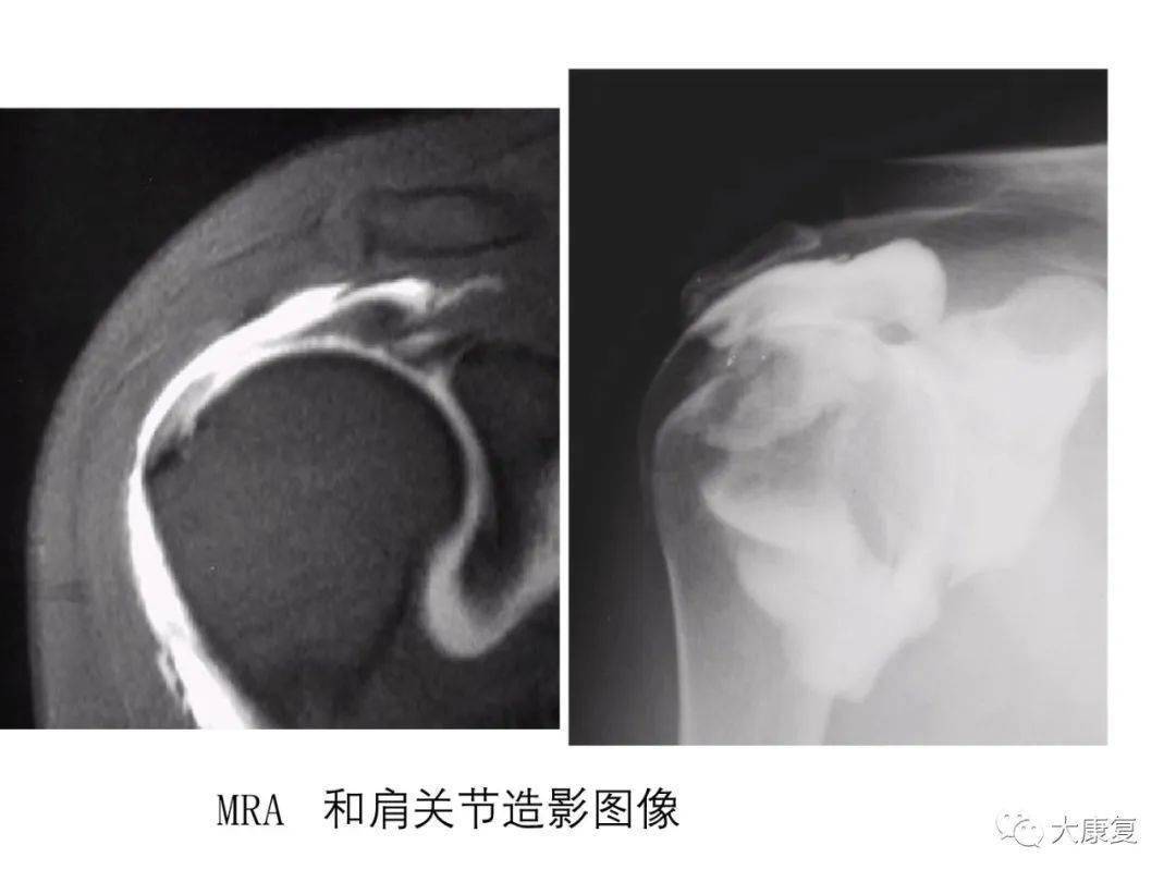肩关节运动损伤影像诊断