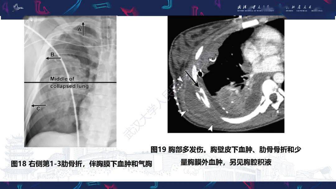肋骨病变影像诊断