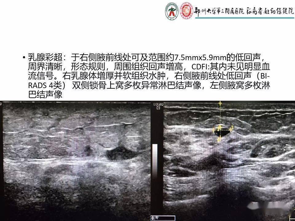 非哺乳期乳腺炎性病变与炎性乳癌影像诊断