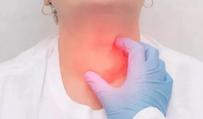 甲状腺治疗排名医院_甲状腺结节图片(2)