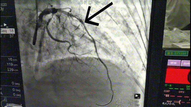 立即转入介入导管室,给患者行急诊冠脉造影显示:心脏前降支闭塞,回旋