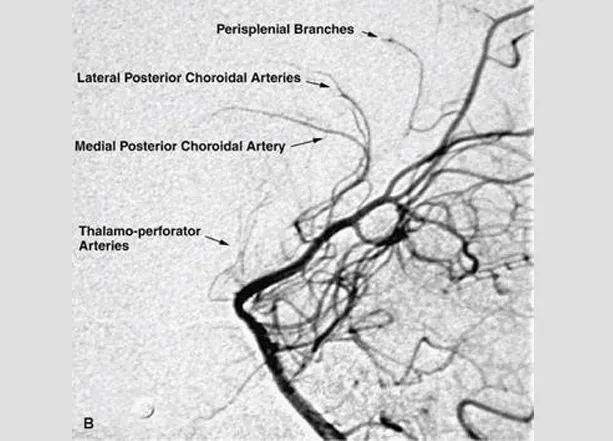 dais讲坛丨从基底节区脑动静脉畸形探讨基底节区血运
