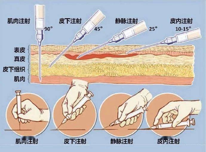 也分这几种注射方式, 比如: 乙肝疫苗是肌肉注射; 卡介苗则是皮内