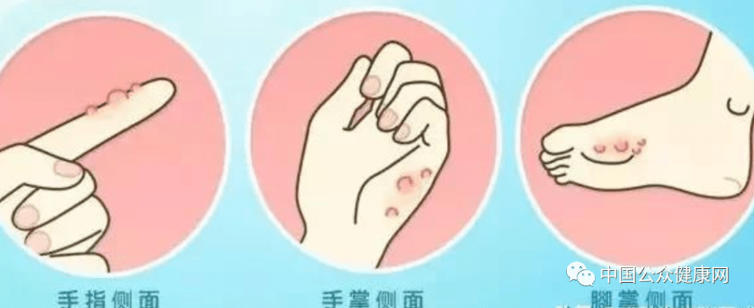 为啥一到夏天 手上就容易长奇痒无比的小水泡 水疱