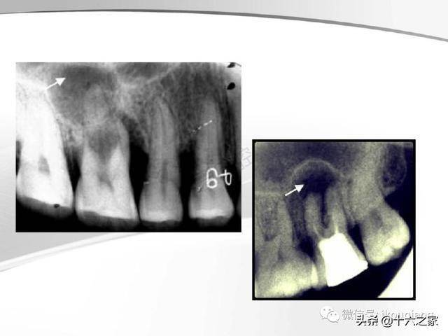 牙及牙周各种疾病影像学表现整理