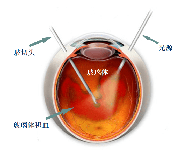 5,玻璃体腔内注射是治疗糖尿病视网膜病变重要手段.