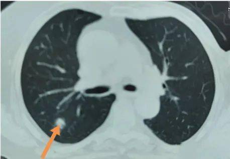 肺上的疤痕在影像学上怎么说