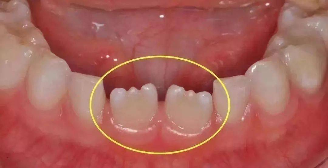 小孩牙齿为什么呈锯齿状_钙化
