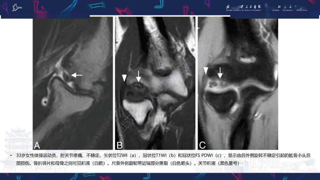 肘关节mri:解剖及侧副韧带复合体常见损伤(下)