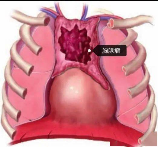 胸痛,胸闷,咳嗽快速加重?警惕胸腺瘤